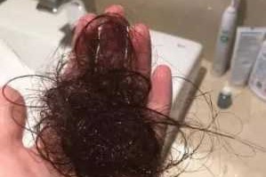 最近掉挺多新长出的细小的头发怎么回事,初中女生掉头发严重是什么原因