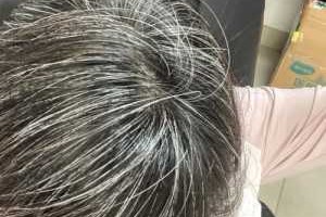 满头白发怎么治（白头发越来越多有什么妙招）