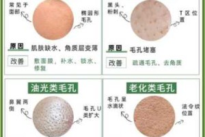 黑头毛孔粗大怎么去除最有效,脸上毛孔粗大黑头多怎么办怎么改善