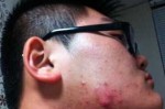 为什么脸上起痘痘（为什么脸上起痘痘痒）