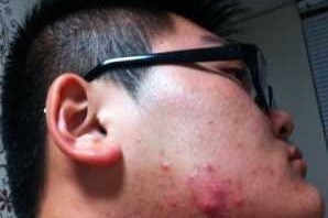 为什么脸上起痘痘（为什么脸上起痘痘痒）