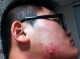 为什么脸上起痘痘（为什么脸上起痘痘痒）