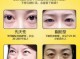 眼袋是怎么消除（怎样治眼袋？可以去掉吗）