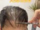 男性头发稀少怎么办（男性头发稀少怎么补救）