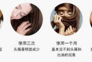 正确洗头去头屑的方法和步骤,怎么祛除头皮屑最有效