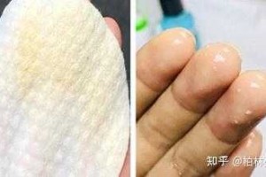 怎么洗去黑头（黑头清理方法）