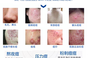 脸上长痘痘怎么消除,脸上起粉刺怎么去掉小妙招