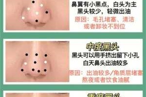 鼻头黑头怎么去除,鼻头黑头怎么去除最有效小妙招
