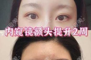 额头高怎么（额头高怎么改善）
