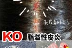 头皮坏了怎么办（头皮坏了怎么办?）