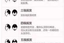 中年脱发怎么治疗（〓我舅舅，爸爸都中年脱发，我以后脱发的几率有多大？如何养发）