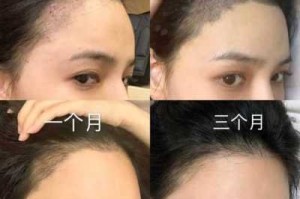 女额头头发稀少怎么办（女额头头发稀少怎么办图片）