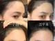 女额头头发稀少怎么办（女额头头发稀少怎么办图片）