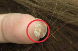 头顶头皮痒而且还脱发是什么原因,头皮发痒脱发怎么办啊