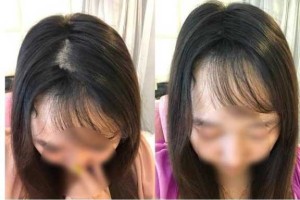 前额秃怎么办（前额秃怎么办女生）