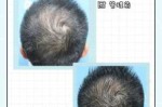 脱发的原因都有哪些呢,什么造成脱发严重