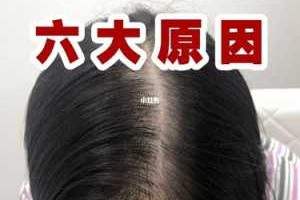 女人脱发严重是怎么回事,女生为什么脱发严重怎么办