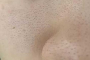 为什么脸上的毛孔张开了,脸上毛孔多是什么原因引起