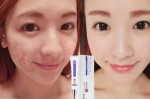 怎么才能有效去痘印（去痘印有什么好方法）