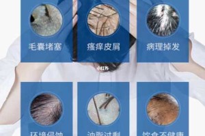 头皮屑的由来,头屑是怎么产生的原因