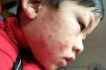 脸上爱起痘痘怎么回事（脸上红色的痘痘是怎么回事）