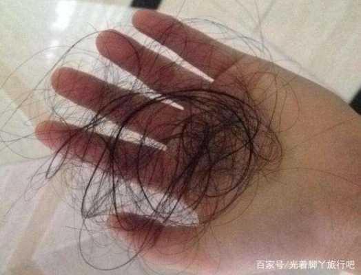 头发掉的厉害怎么办（严重掉头发怎么治疗）