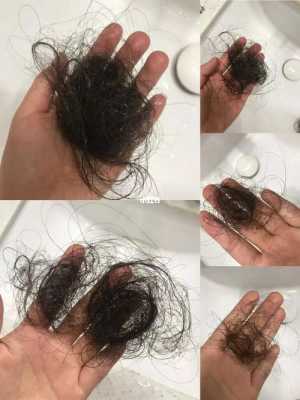 头发掉的厉害怎么办（严重掉头发怎么治疗）