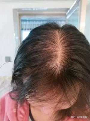 头发稀少怎么改善（头发变少怎么办）