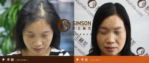 头发怎么种植,怎么样种头发好看
