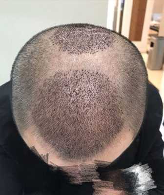 头发怎么种植,怎么样种头发好看