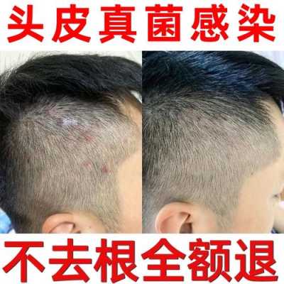 头皮屑多怎么治疗（头皮屑多怎么治疗偏方）