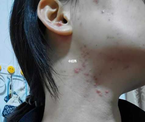 下巴长痘痘怎么回事（女士下巴长痘痘怎么回事）