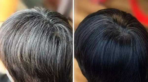 治疗白发最好的方法,白发怎么治疗能根治