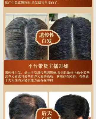 治疗白发最好的方法,白发怎么治疗能根治
