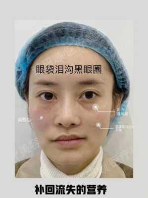 怎么样消除眼袋（怎么样消除眼袋效果好）