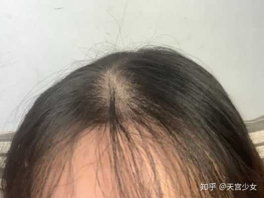 头发少是什么原因（头发少是什么原因引起的,怎样调理）