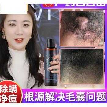 头屑太多怎么去除,头屑太多怎么办 用什么洗发水