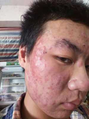 脸上长青春痘怎么办（脸上长青春痘怎么办13岁）