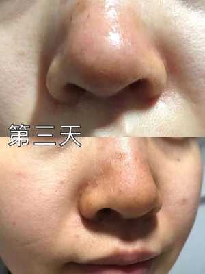 鼻子上的黑头怎么办（鼻子上黑头多怎么去除）