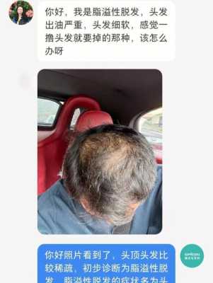 油脂性脱发怎么治（油脂性脱发怎么治）