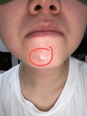 女生下巴长痘怎么调理（下巴长痘痘红肿硬硬的还疼怎么解决）