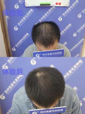 怎样生发育发,怎么生发最有效方法
