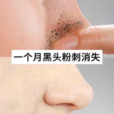 鼻子上的黑头怎么去除简单方法（鼻子有黑头怎么去除）