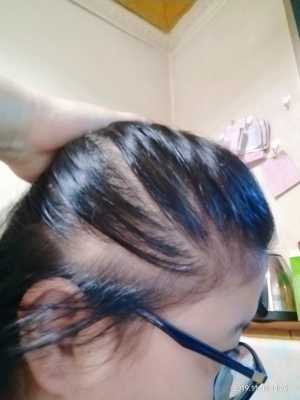 头发爱出油怎么解决（头发爱出油怎么解决女）