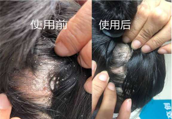 怎么去除头皮屑（怎么去除头皮屑最有效方法）