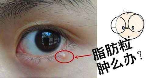 眼角的脂肪粒怎么去除（眼角脂肪粒的正确消除方法）