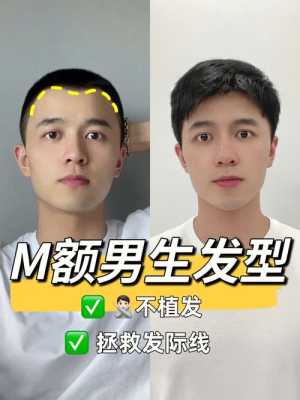 m型发际线适合什么发型（m型发际线适合什么发型）