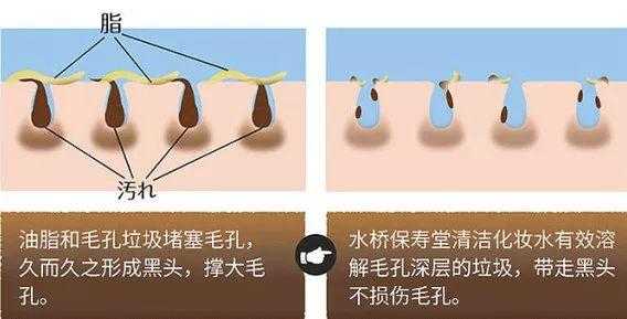 黑头怎么去除,12岁有黑头怎么去除