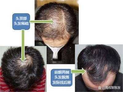 掉头发严重是什么原因（掉头发严重是什么原因男性）