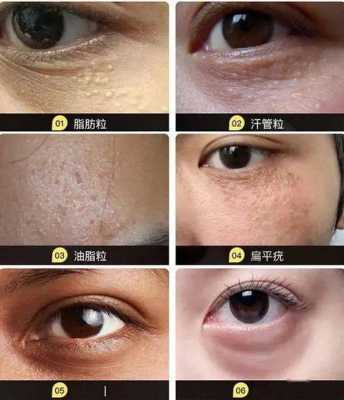 脂肪粒怎么形成的（为什么油脂粒会从毛孔里自己出来）